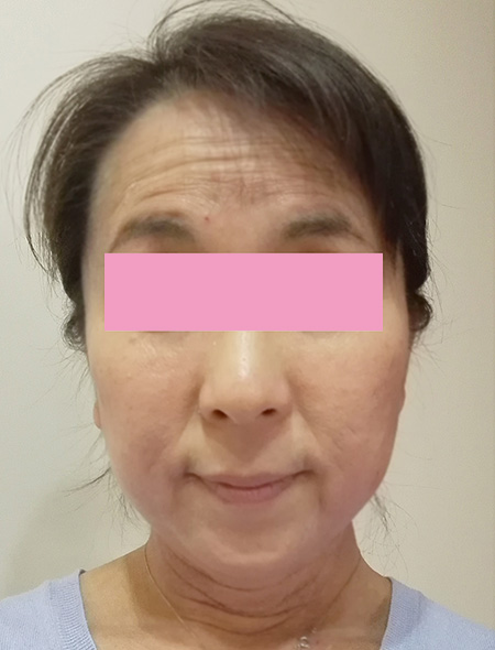 小顔矯正 小顔矯正