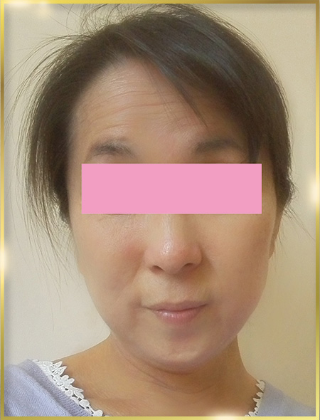 小顔矯正 小顔矯正