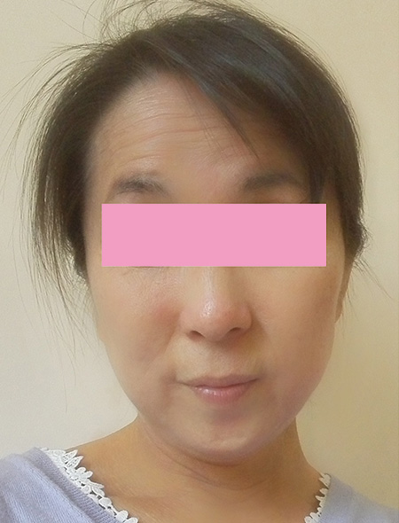 小顔矯正