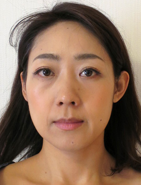 小顔矯正 小顔矯正