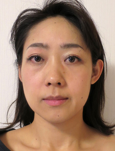 小顔矯正